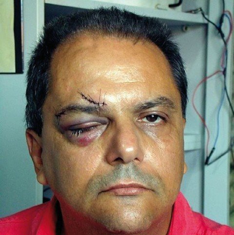 jornalista-e-agredido-violentamente-1 André está em uma clínica especializada em oftalmologia, em função dos fortes hematomas em seu olho