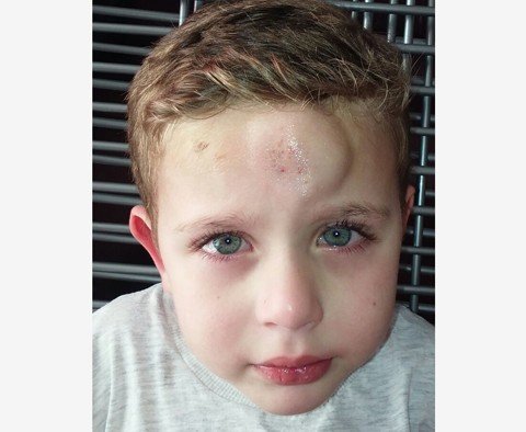 crianca-passara-por-diagnostico-em-curitiba-1 Os hematomas ocorrem devido às crises que o pequeno Brayan sofre. - Foto: Arquivo da família/Divulgação/Notisul.