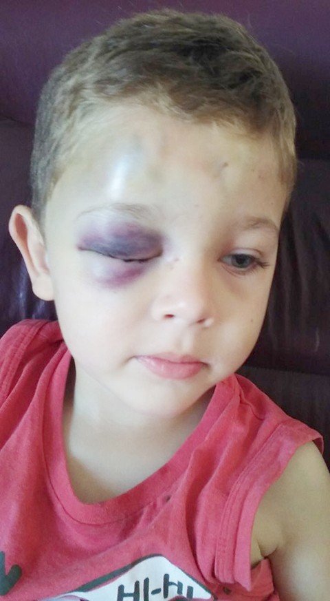 anvisa-libera-canabidiol-a-menino-da-regiao-1 Brayan fica com vários hematomas devido às constantes quedas que têm quando perde os sentidos em decorrência da Síndrome de Doose. - Foto: Arquivo da família/Divulgação/Notisul.
