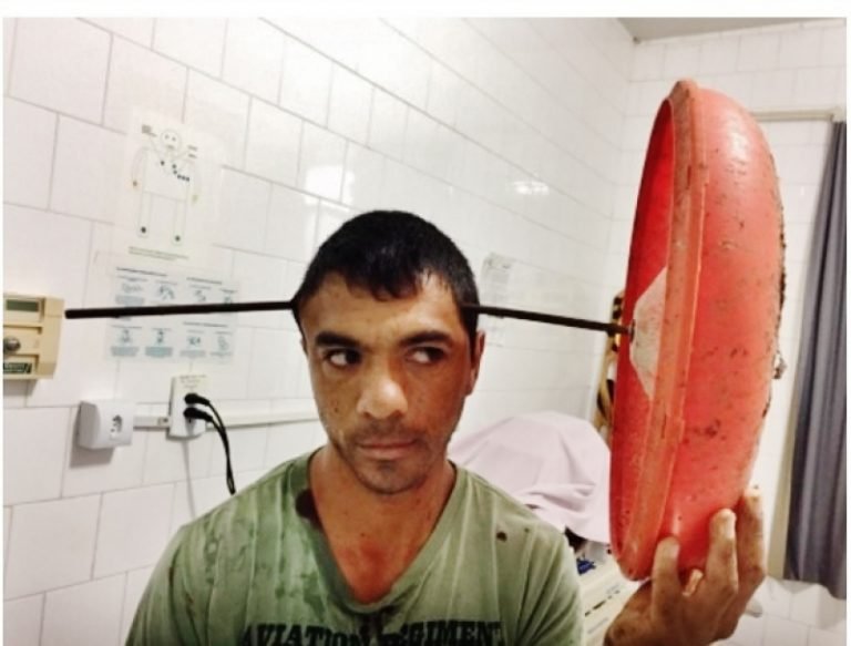 Homem tem cabeça atravessada por peça metálica