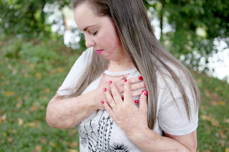As marcas de Gabriela representam toda a sua trajetória para sobreviver - Foto: Beatriz Juncklaus/notisul