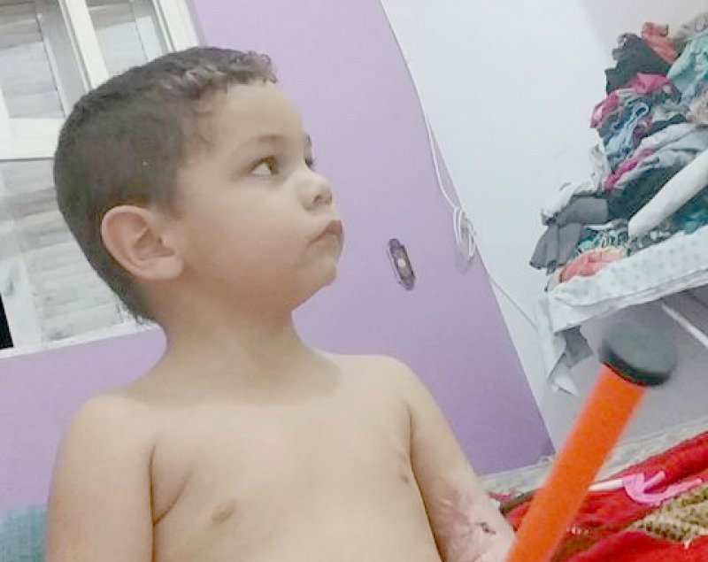 menino-pode-passar-por-cirurgia-em-breve-0 O menino teve 30% do corpo queimado - Foto: Divulgação/Notisul