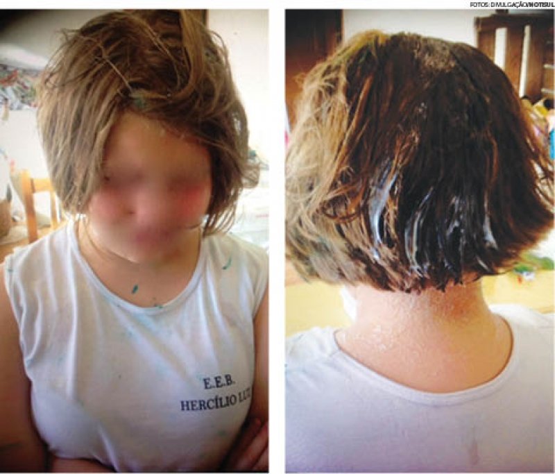 bullyng-crianca-afirma-ter-sido-agredida-na-escola-0 Para tirar o produto do cabelo da menina, a mãe disse que foram necessárias quase três horas de limpeza profunda - Fotos: Divulgação/Notisul