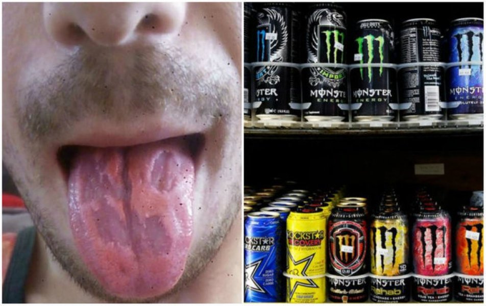 professor-fica-com-a-lingua-corroida-apos-tomar-seis-energeticos-por-dia-1