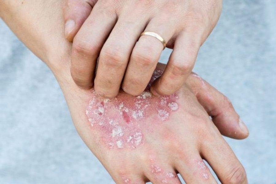 como-tratar-a-psoriase-naturalmente-0