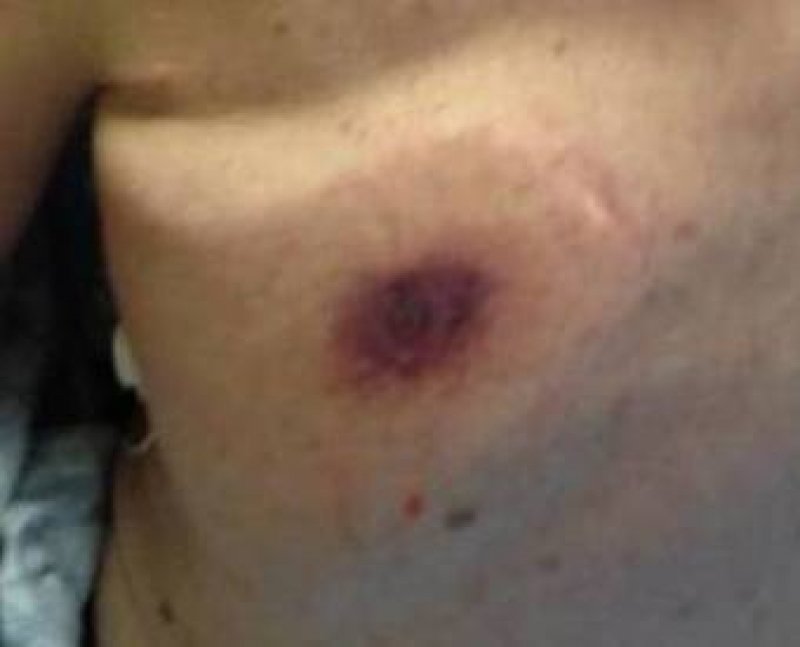 florida-homem-morre-48-horas-depois-de-contrair-bacteria-que-come-carne-1