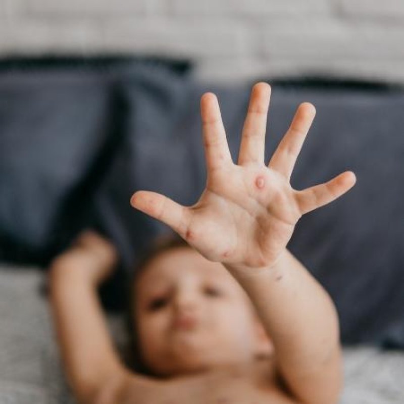 oms-numero-de-casos-de-sarampo-e-o-mais-alto-no-mundo-em-13-anos-1