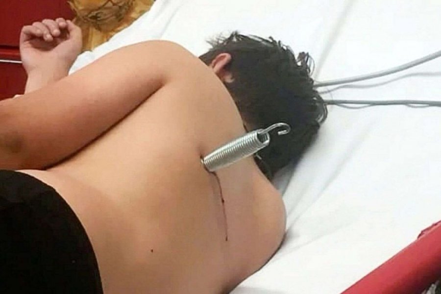 crianca-sofre-acidente-em-pula-pula-e-fica-com-mola-cravada-nas-costas-1