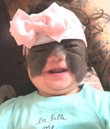 A beb&ecirc; com o curativo ap&oacute;s a primeira cirurgia