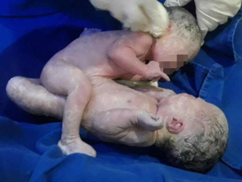 no-pais-gemeas-siamesas-recebem-alta-e-passam-bem-1