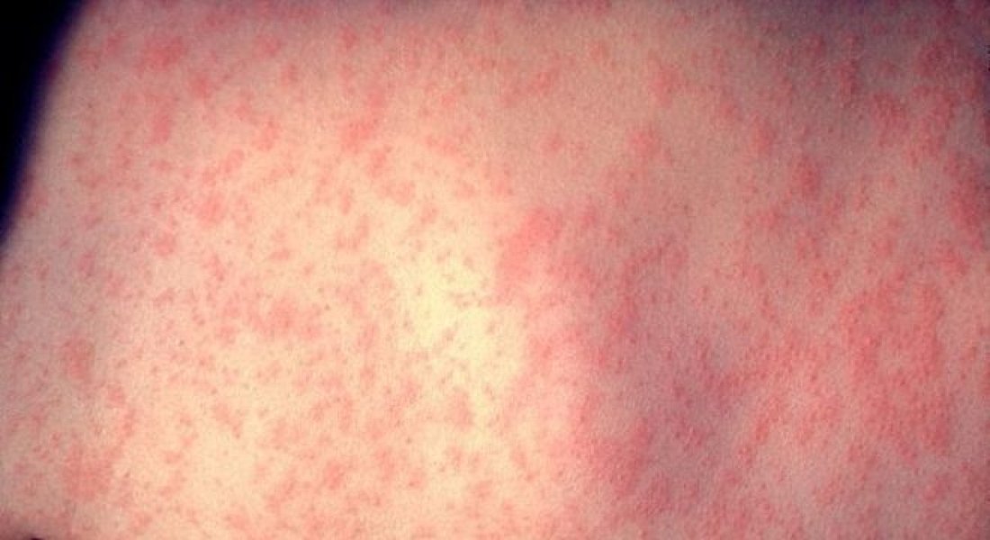 vigilancia-de-sc-confirma-caso-de-sarampo-em-show-1