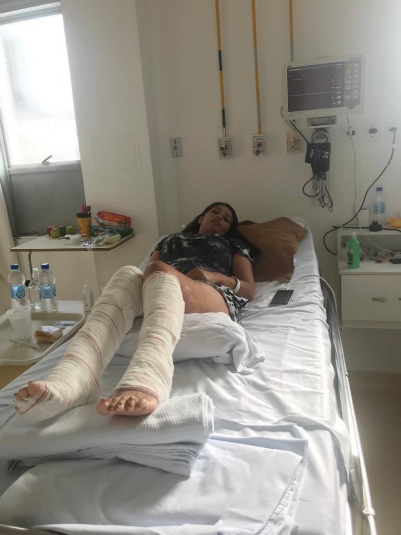 apos-sofrer-queimaduras-moradora-de-imbituba-tera-que-fazer-enxerto-de-pele-1