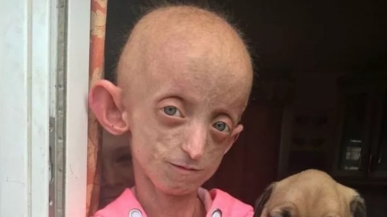 Inglesa morre de ‘velhice’ aos 18 anos devido a distúrbio raro