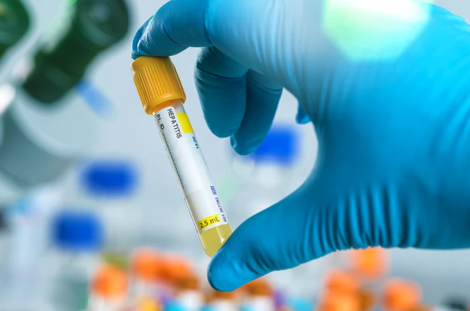 Hepatite #PraCegoVer Na foto, uma pessoa usa uma luva azul e seguro um frasco onde foi coletado material biológico para um teste de hepatite