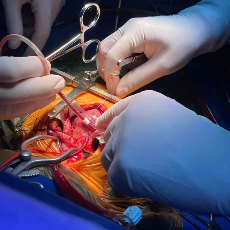 Santa Catarina realiza cirurgia inédita em bebê para tratar condição congênita rara